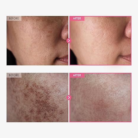 Arbutin (7%), Tranexamic Acid (4%) Brightening Cream